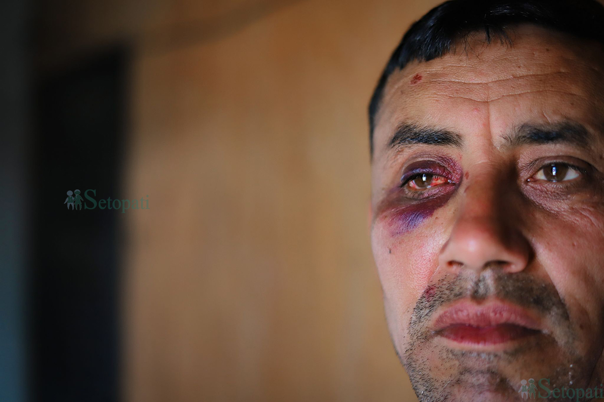 काठमाडौं महानगरका नगर प्रहरीको लाठी र बुट प्रहारबाट बुधबार राति घाइते भएका सडक व्यवसायी बद्री देवकोटा। तस्बिरहरू: निशा भण्डारी/सेतोपाटी